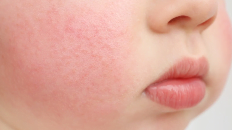 parvo virusas vaikams ir suaugusiems berimas