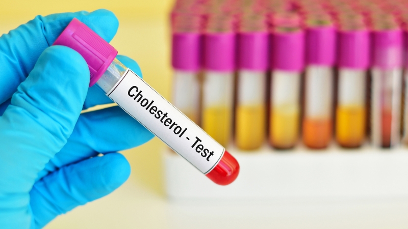 Cholesterolio tyrimai ir gydymas