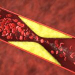 dislipidemija ir hipercholesterolemija