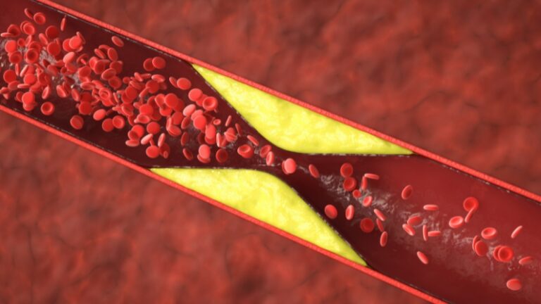 dislipidemija ir hipercholesterolemija
